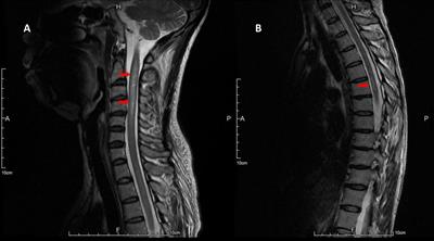 Case Report: Severe rebound after withdrawal of fingolimod in a patient with neuromyelitis optica spectrum disorder